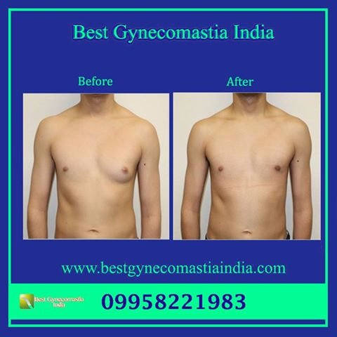 Get the best Gynecomastia surgery in India at KAS Medical Center. For any kind of enquire about gynecomastia surgery contact form or call +91- 9958221983.