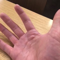 Being painfully electrocuted (beyond pre-existing Raynaud's Syndrome) since July 2015