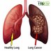 Non Small Cell Lung (@nsclc_cancer) Twitter profile photo Non Small Cell Lung (@nsclc_cancer) Twitter profile photo