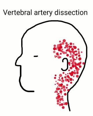 Raising awareness of Vertebral Artery Dissection in the UK