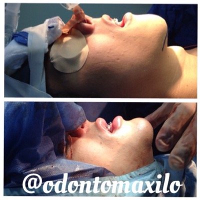 Dr.Alexis Ramos T.Cirujano Buco-Maxilofacial. Cirujano adjunto Servicio Cirugía Plástica y Reconstructiva HUC.Profesor de Pregrado y Postgrado Odontologia UCV🔃