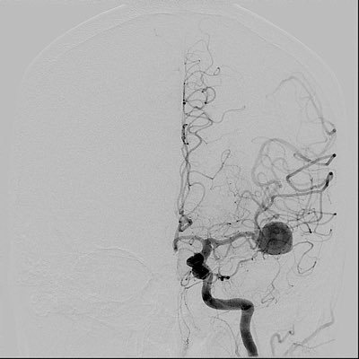 Les jeunes en Neuroradiologie Interventionnelle / Young Interventional Neuroradiologists in France.