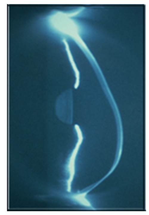 keratoconus's profile picture. Important updates for keratoconus sufferers around the world.  If you have keratoconus, can't wear contact lenses or told about a corneal transplant, READ ON