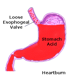 StomachAcid's profile picture. The diary of inconvenient Acid Reflux. Documenting it to overcome it.
