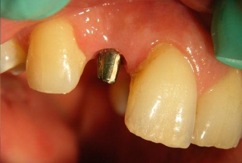 Dental Tooth Implants in the UK are becoming a more popular choice to replace missing teeth. Visit our UK website to learn more http://t.co/iFGhqXzmKu