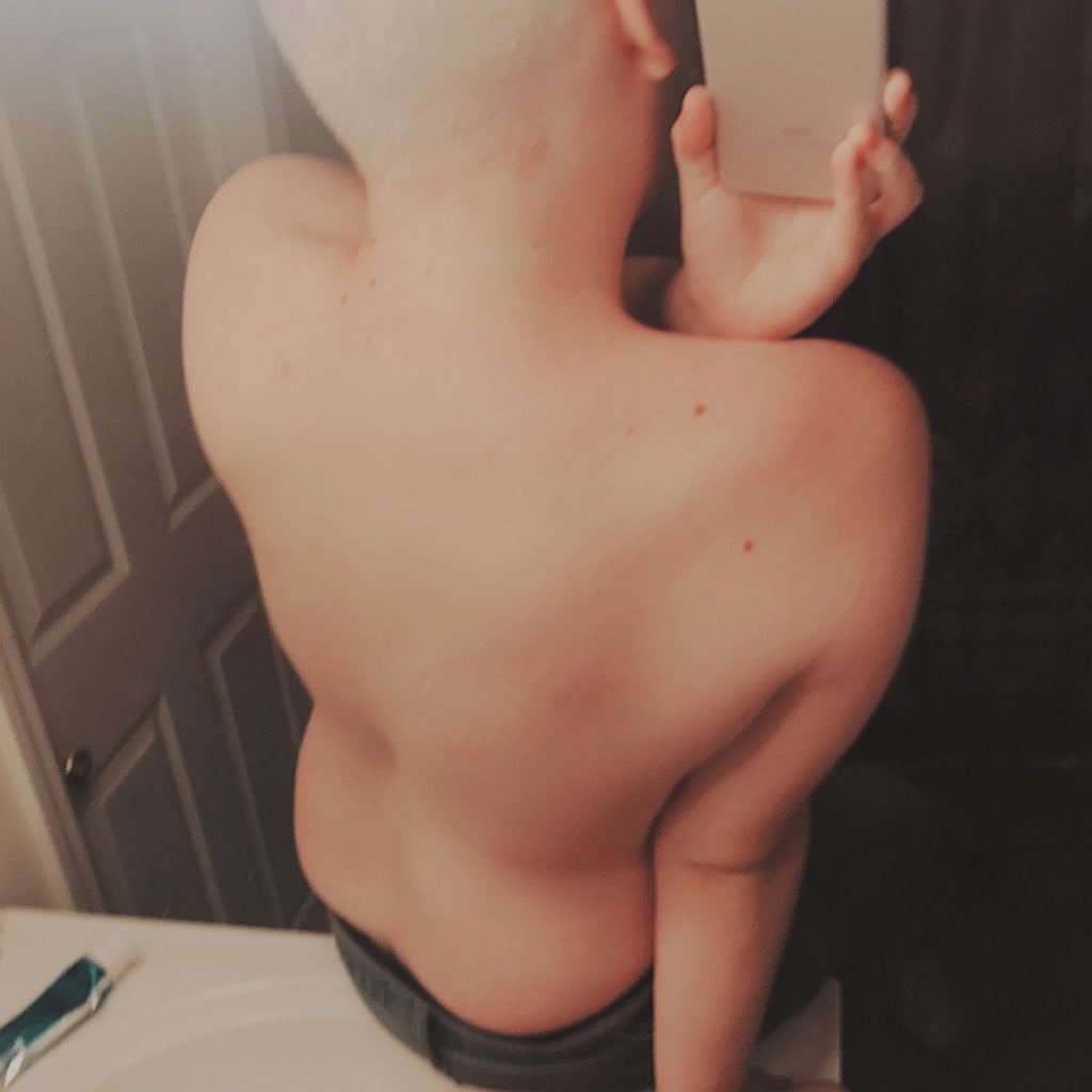 oxyTimmy's profile picture. starvation and oxycodone are my life. SW: 194. CW: 138.0 LW: 125 UGW 97. it's been years of on and off starving. I need to do it right not pro anything