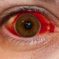 Home to your entire eye problem itching, Redness, burning, swollen and hurting, follow me for  best remedy and cure #eye #cure #remedy