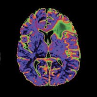 UCSF Neurosurgery(@NeurosurgUCSF) 's Twitter Profileg