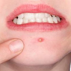 ニキビ改善 胃腸が弱い方は口周りにニキビができやすいんです ニキビができてしまったら 胃 にやさしいもの 消化のいいものを食べるようにしましょう ニキビ改善 胃腸が弱い方は口周りにニキビができやすいんです ニキビができてしまったら 胃 にやさしいもの 消化のいいものを食べるようにしましょう