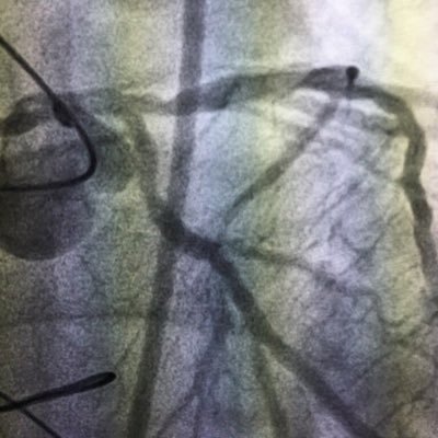 Critical view of interventional devices & techniques, let’s keep patients first. Tweets are on my own personal opinion and not medical advice.