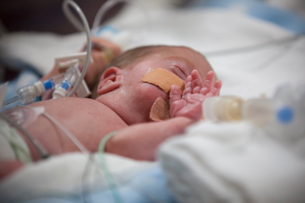 Intratracheal budesonide + surfactant to ⬆️ survival free of BPD in extremely preterm infants | @nhmrc @MCRI_for_kids @chiesigroup @thrasherfund