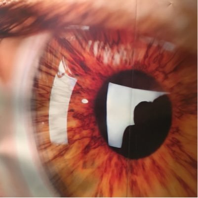 Vitreo-Retina Specialist, Medical Director @ American Eye & Retina Center Erbil, Iraq.  Med Sch: Univ. of Texas. Residenc: Univ of Kansas.  Fellowship: Harvard