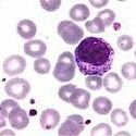 LeucemiaMC_VZLA's profile picture. Leucemia Mieloide Crónica