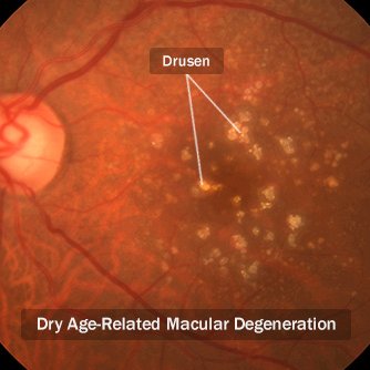 Investigation and Medical Treatment of Macular Degeneration