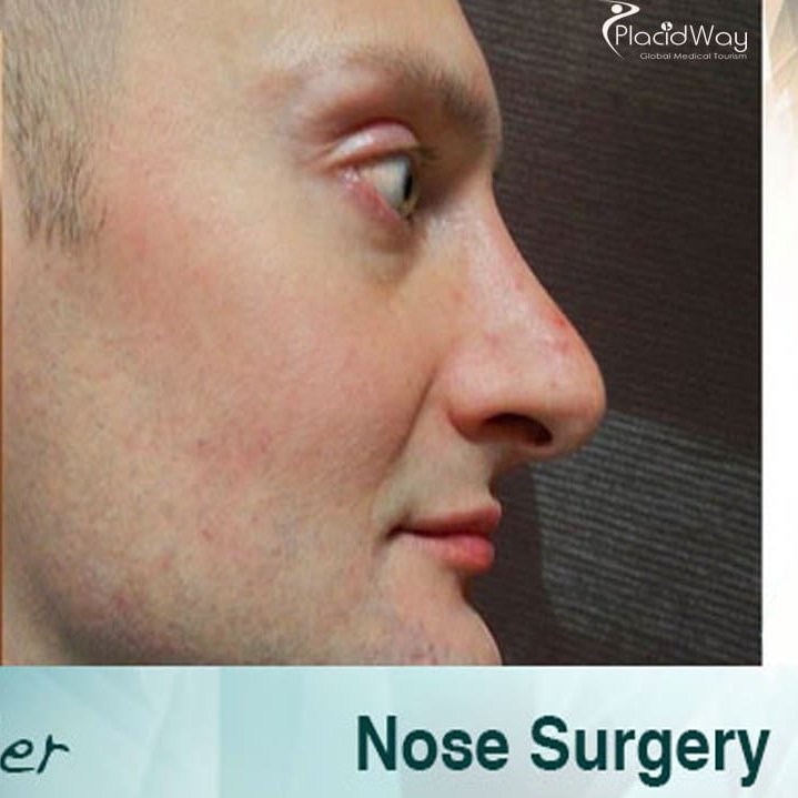 Contact us now to know more about the Rhinoplasty procedure.