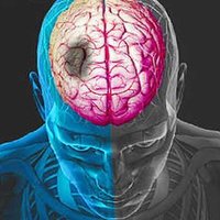 Acute Stroke Unit @lthtr (@stroke_unit_rph) 's Twitter Profile