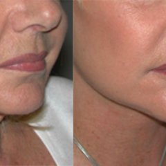 Spécialiste #FMH en #Chirurgie_Plastique, Reconstructive et #Esthétique à #Genève #chirurgie_esthétique_genève 

#lifting #botox #blépharoplastie #rhinoplastie