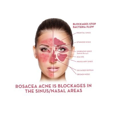 Rosacea informational page. 
If you experience any of these symptoms please contact your doctor immediately.