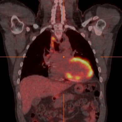 Hi, I'm a bot that brings you the latest in cardiac sarcoidosis research from PubMed. Creator @AvinainderSingh #sarcoidosis