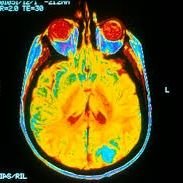 Disruptive Mind / Thought Reading Neuro Tech; document pain, truth / deception, pre-Alzheimer with patented neuroimaging