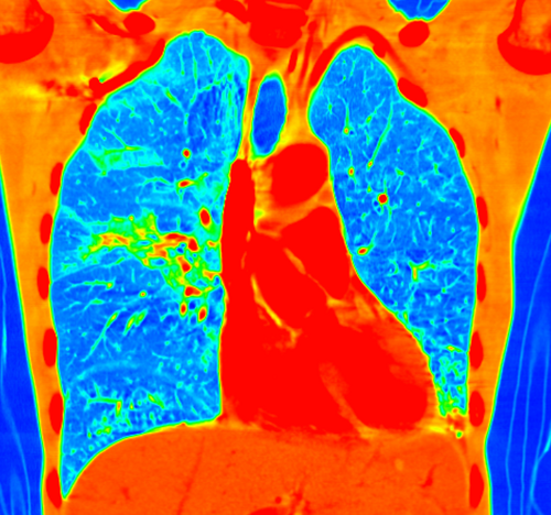 Chest doctor in Tayside, Honorary Professor University of Dundee, Respiratory Lead Centre for Sustainable Delivery, runner, cyclist, SFV masher, house trained.