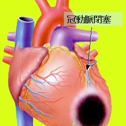 心臓左冠動脈バイパス手術のパパさん Bg0qk4xerui3ppb Twitter
