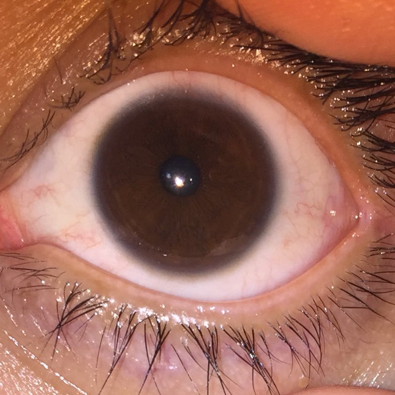 suffer from dryeyes//severe dry eye awarness//
