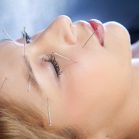 Cosmetic Facial Acupuncture is the insertion of fine needles into wrinkle lines. Reducing their visibility, leaving a smoother, firmer more youthful complexion.