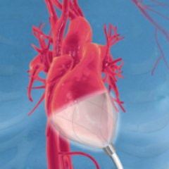 Developing a nonblood contacting biventricular cardiac assist device for patients with acute heart failure. Based at JLABS @ TMC, TMC Innovation Factory.
