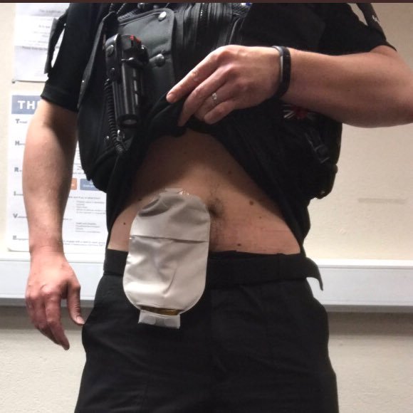 Serving Sgt on Response. Ulcerative Colitis, Surgery’16 and now live and work with a stoma and bag. Play Rugby for TeamColostomyUK to spread awareness