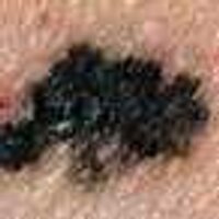 Melanoma expert docs (@melanoma_drs) 's Twitter Profile