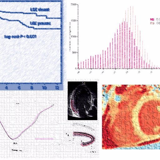 #echocardiography #Cardiovascular #echofirst #HeartDisease #HeartFailure #cvImaging #cardiology #CVD #cardiotwitter #cardiology  #EACVI2023