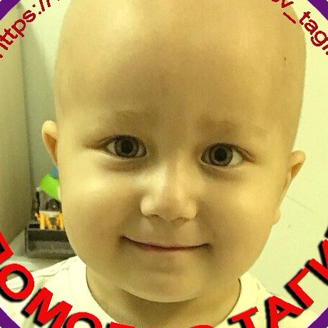 His boy's name is Maksumzyanov Tagir 05/05/2015
ACUTE LYMPHOBLASTIC LEUKEMIS
TRANSPLANTATION OF THE BONE MARROW IN ISRAEL IS
REQUIRED
To collect 323 500 USD