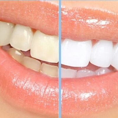 We are the #1 cosmetic teeth whitening in the US. Get your teeth 2-8 shades whiter in just 30 minutes and feel instantly more confident. Call us 401-227-4050