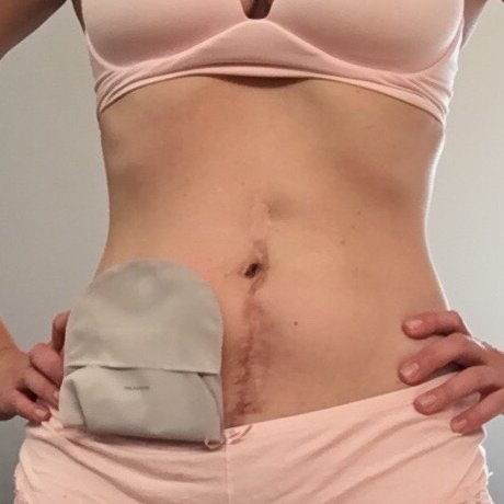 A permanent ostomate with all the right ingredients but fallopian tubes damaged by Crohn's and surgeries is trying to get good and pregnant at age 36.