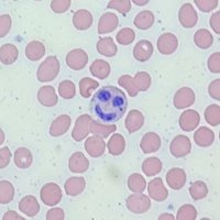 Hematologia ICO Girona - Josep Trueta (@hematogir) 's Twitter Profile