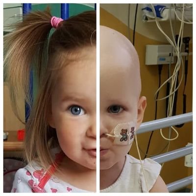 Tazmin was diagnosed with myelodysplasia which turned into AML leukemia now in remission following a bonemarrow transplant  in oct 17 facebook group below 👇