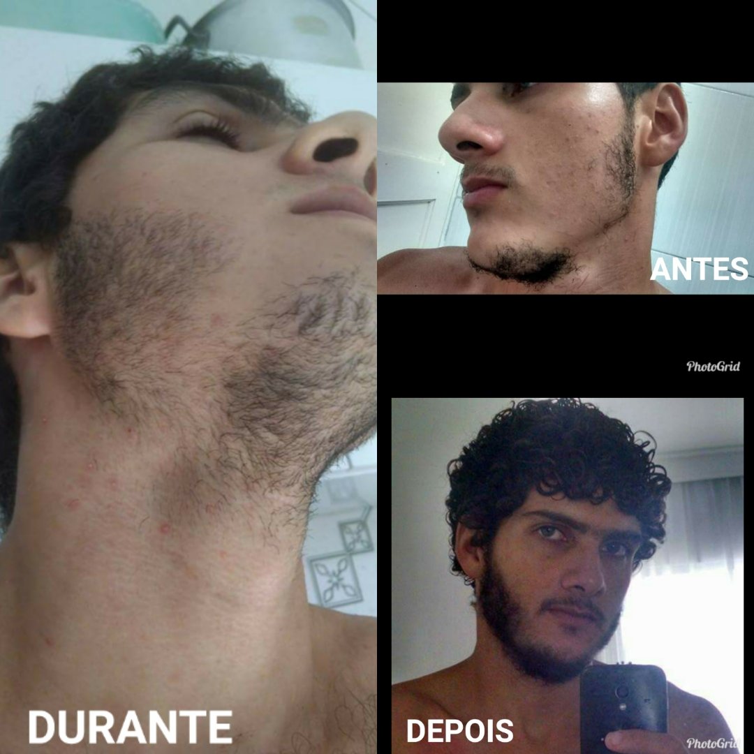 Revendedor Minoxidil 5%
Entrega em mãos , a combinar. ( Salvador/BA)
E vendas através do Mercado Livre.
Whatsapp - 7198712-1491. Paulo Vitor
