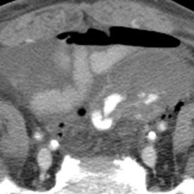 SAR GI Bleeding DFP Profile