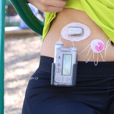 human pin cushion & certified carb counter - #T1D since 2006 - Tandem T-Slim and Dexcom G6