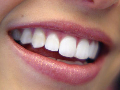 Latest news, trends on teeth whitening, tooth whitening, and bleaching.