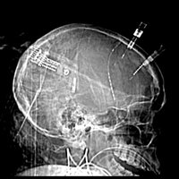 Collaborative for Research on Acute Neuro Injury (@uc_crani) 's Twitter Profile