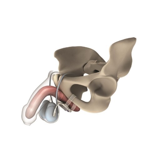 ATOMS - Adjustable Trans Obturator Male System for all degrees of Urinary Incontinence. Unique adjustability for quick & easy adjustment post-operatively.