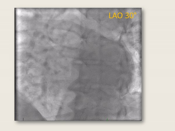 Today´s rare finding: Single coronary artery. CX takes over entire RCA territory.
#cardiotwitter @Drroxmehran @mirvatalasnag @mmamas1973 @EuroInterventio @escardio @JEscaned