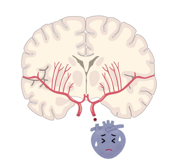 心原性脳梗塞のtwitterイラスト検索結果