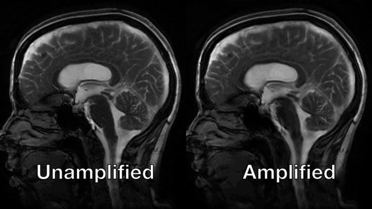 Watch the brain jiggle with each heartbeat. http://ow.ly/E3uA30kFBgpΒ