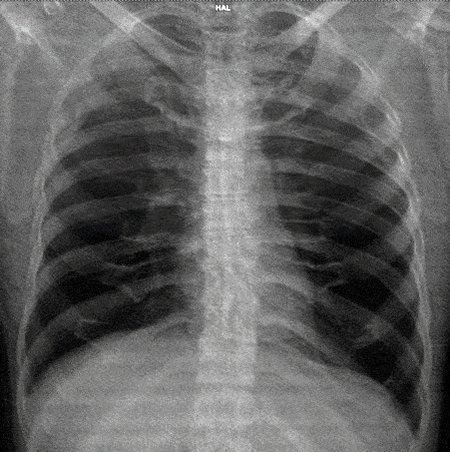 Here’s a great teaching GIF to help see the 3D relationship between a frontal and lateral Chest X-Ray!
Courtesy: @ochsnerrads
#FOAMed