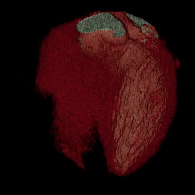Have an achy breaky heart? Cardiac CT can help doctors better assess the source of your chest pain, finds study. #CT #HeartDisease #HeartMonth #HeartHealth @NEJM https://invent.ge/2S4ohnI