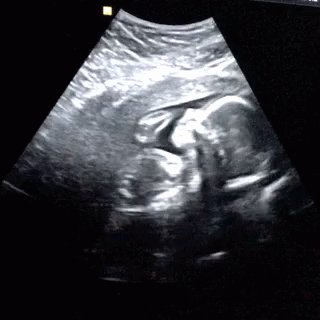 Ultrasound Baby GIF