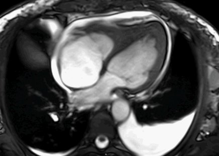 Thickened LV apex with preserved regional/global systolic fu